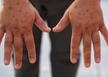 Imagem de mãos com lesões características de mpox, vírus que está em expansão no Brasil em 2026.